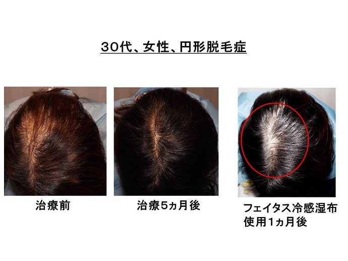 円形脱毛症　病院